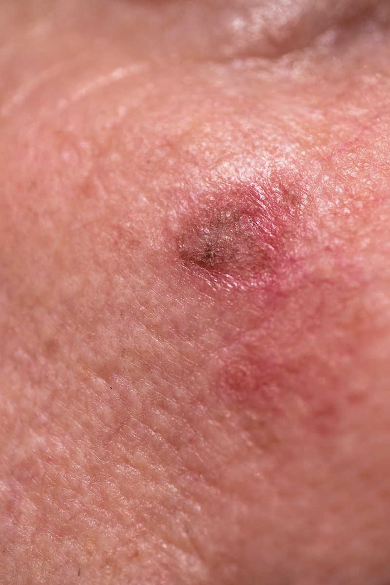 Lymphomes B diffus à grandes cellules en rechute/réfractaire les ≥ 65 ans bénéficient aussi