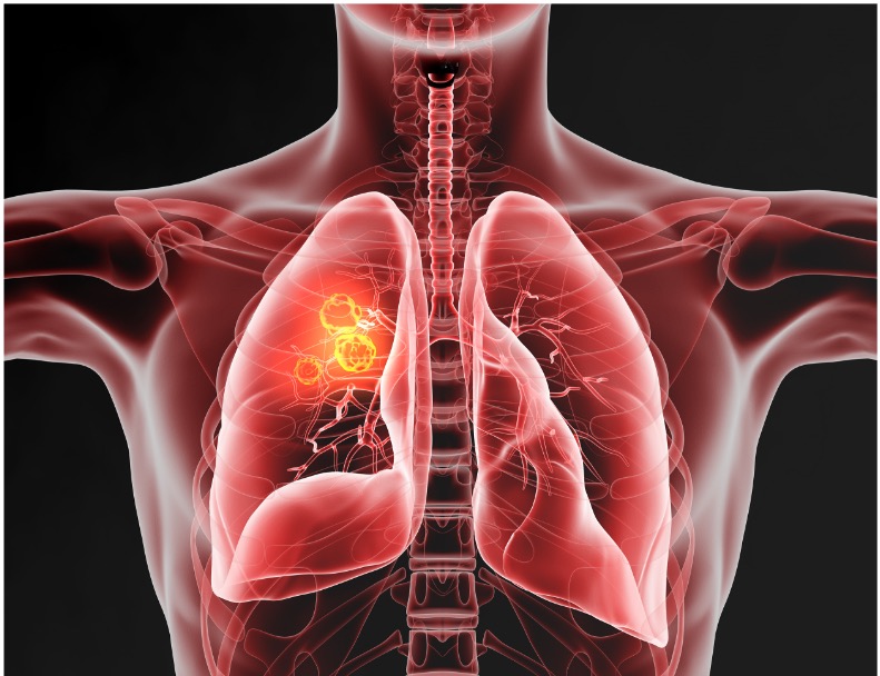 Cancer du poumon : la BPCO, source de complications ...