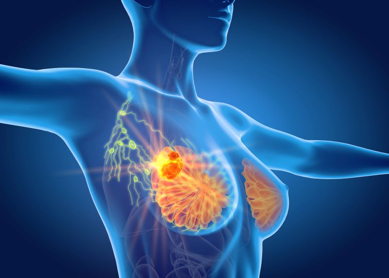 Cancer du sein métastatique HR+/HER2- Les récepteurs hormonaux corrélés à  la survie sans progression - MediQuality
