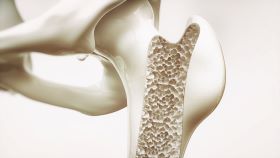 Osteoporosis bone