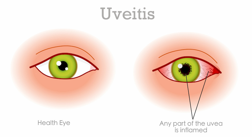 uvéite antérieure