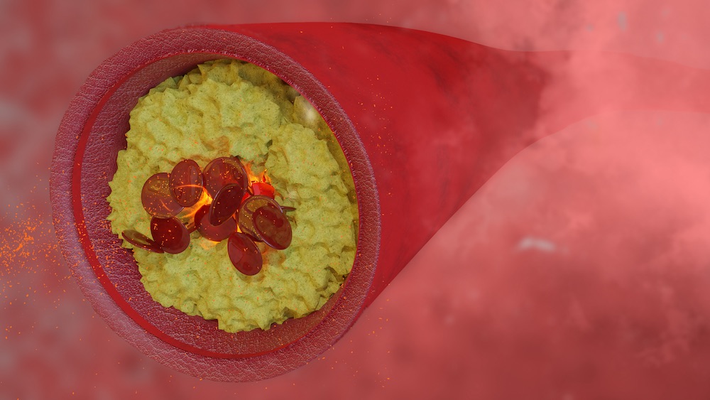 Cardiovasculair Risico Bempedo Nezuur Lost Verwachtingen In Mediquality