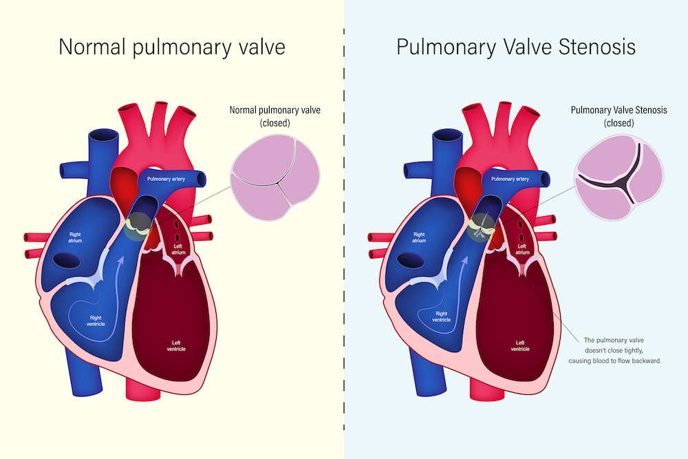 Remplacement de valves pulmonaires et endocardites infectieuses : quel  risque avec la valve SAPIEN ? - MediQuality