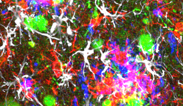 Image confocale montrant des neurones humains transplantés (en vert) et des neurones de souris (en rouge et blanc) chez une souris présentant des plaques amyloïdes (en bleu).