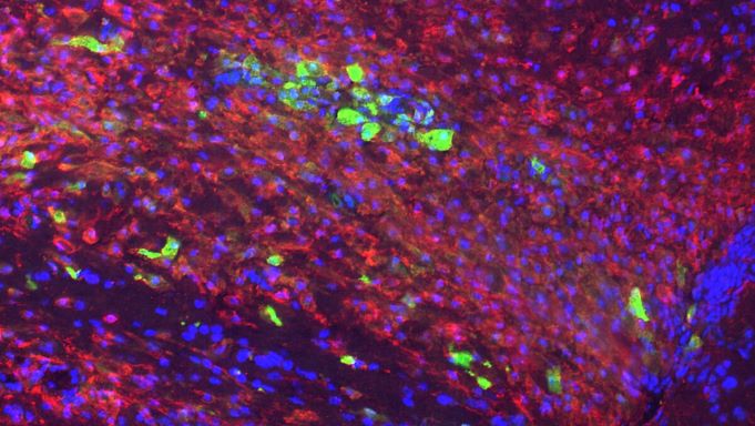 L'image montre la région cérébrale où l'on induit classiquement la démyélinisation. Les cellules rouges correspondent à l'ensemble des cellules microgliales ayant des propriétés inflammatoires quand la démyélinisation vient de se produire. Si le processus de régénération spontanée de la myéline est efficace, leur caractère inflammatoire s'atténue ensuite au profit d'un caractère anti-inflammatoire et pro-régénératif. Les cellules vertes sont une sous-population de ces cellules microgliales qui deviennent anti-inflammatoires. © Zahaf et al.